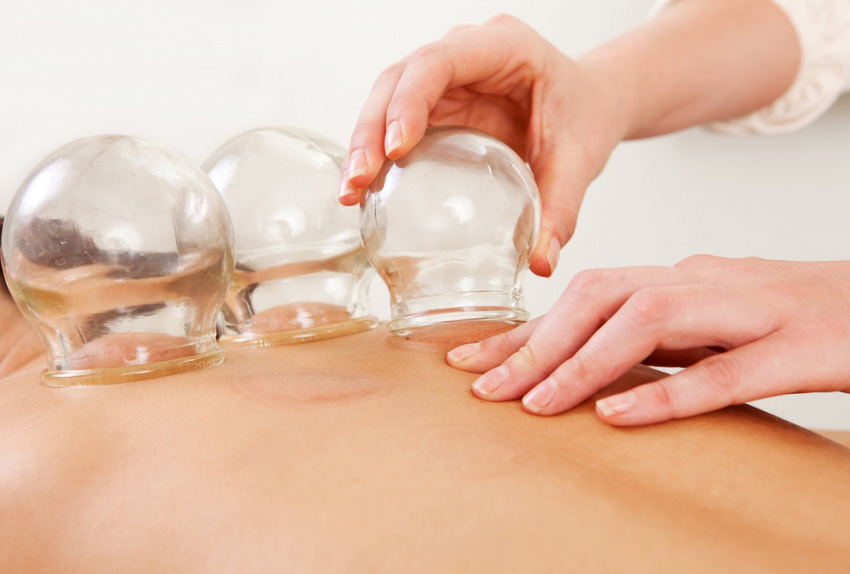 cupping-treatment-sydney-rayford-acupuncture